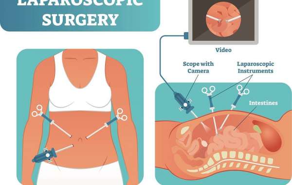 Laser and Laparoscopic Surgery: A Minimally Invasive Approach to Better Health