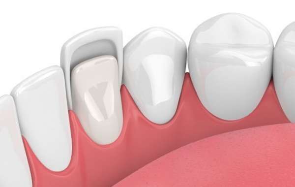 Everything You Need to Know About Dental Veneers in Dartford