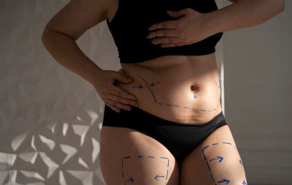Step-by-Step Guide to Mini Tummy Tuck: What to Expect in Dubai