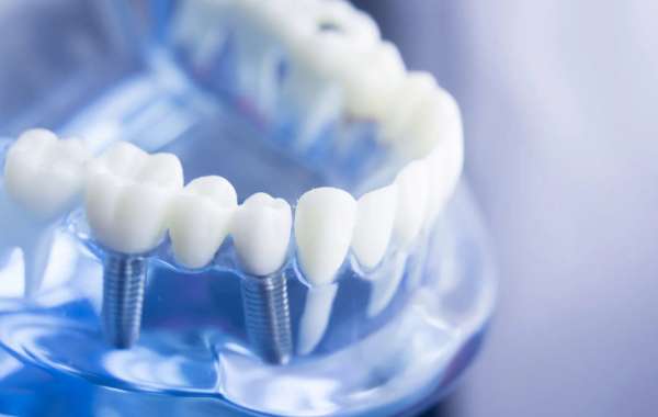 Complete Guide to Denture and Partials in Marietta, GA: Restoring Your Smile with Confidence