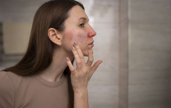 How to Remove Burn Marks from Face: Expert Solutions by Dermatologists in Delhi