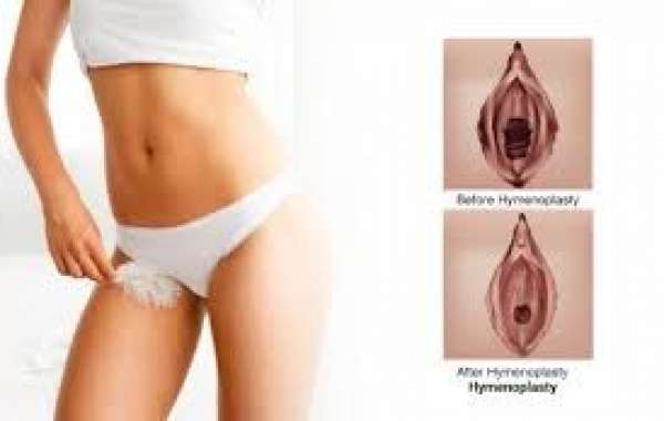 What To Know Before Undergoing Hymenoplasty Surgery?