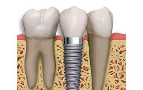 The Ultimate Guide to Dental Implants: Natural, Long-Lasting Tooth Replacement