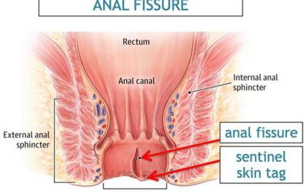 Top Fissure Treatment in Bangalore: Dr. Bhushan Chittawadagi’s Expertise at Your Service