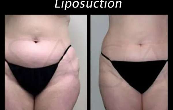 How Much Does Liposuction Cost in Delhi? Discover Excellence with Dr. Shobhit Gupta at Shobhit Aesthetics