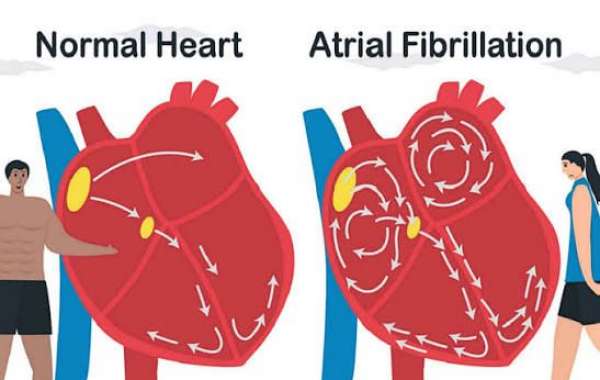 Can Herbal Remedies Help Support Atrial Fibrillation Management?