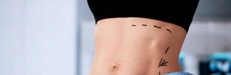 Liposuction in Riyadh Cover Image